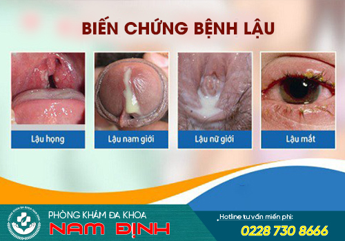 biến chứng bệnh lậu