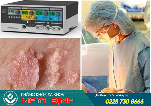 chữa sùi mào gà