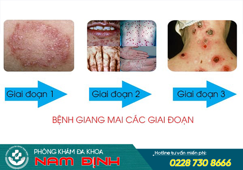 biểu hiện bệnh giang mai