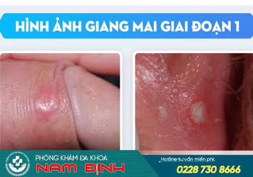 Giang mai giai đoạn 1