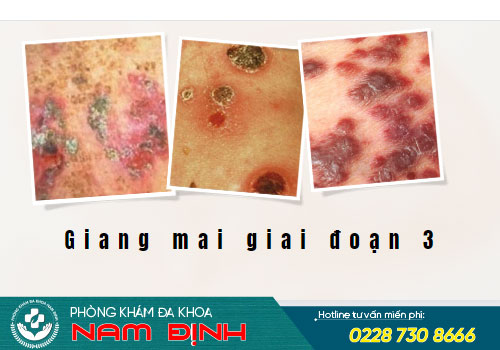 bệnh giang mai