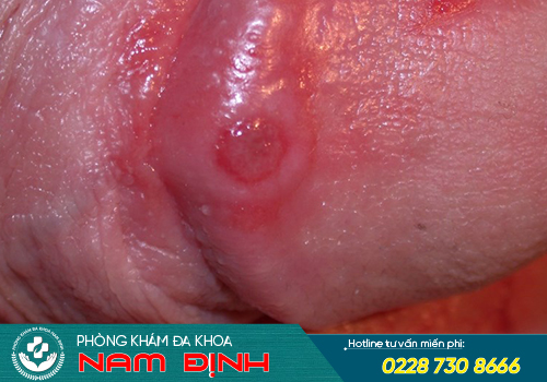 hình ảnh bệnh giang mai