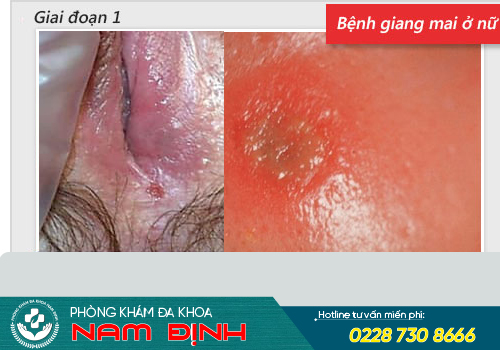 hình ảnh bệnh giang mai