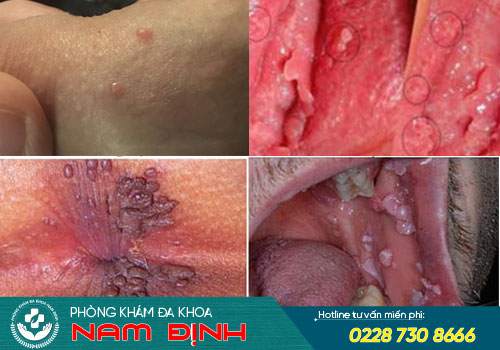 mụn cóc sinh dục