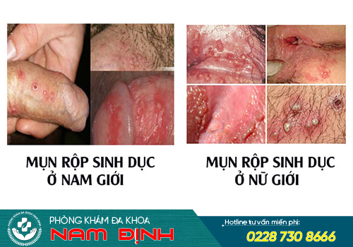 chi phí chữa mụn rộp sinh dục