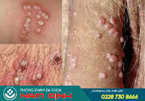 mụn rộp sinh dục