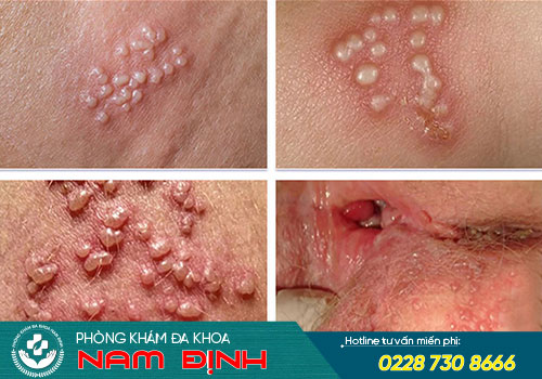 mụn rộp sinh dục nữ