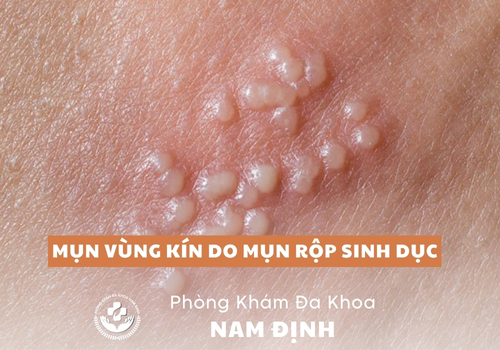 mụn vùng kín