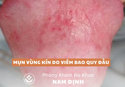 mụn vùng kín
