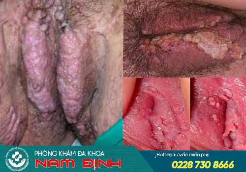 tư vấn sùi mào gà