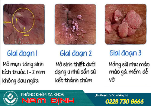 sùi mào gà hậu môn