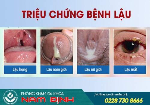 nguyên nhân bệnh lậu
