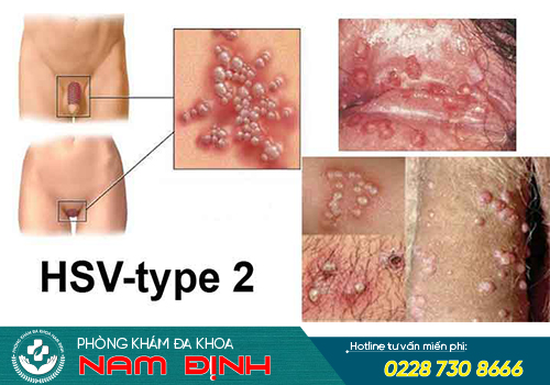 triệu chứng mụn sinh dục