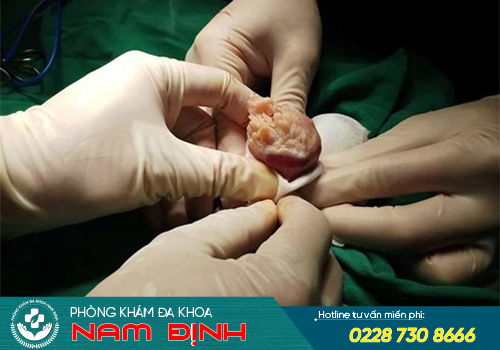 chữa sùi mào gà quy đầu